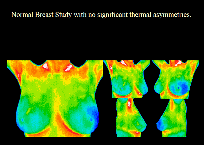Breast Thermography  The below image is a normal breast study, with no significant thermal asymmetries.  (Early detection of breast disease with no radiation)